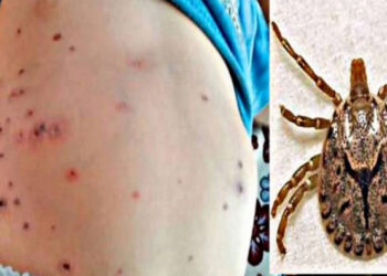 किर्नाले टोक्दा कोरोना जस्तै लक्षण देखिन थाल्यो